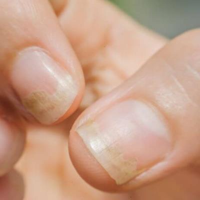 Perubahan Bentuk atau Ketebalan Kuku