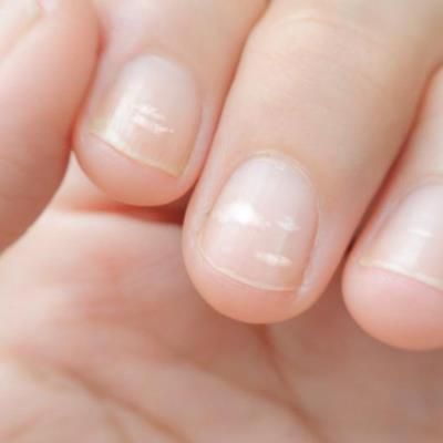 Munculnya Garis atau Titik Pada Kuku