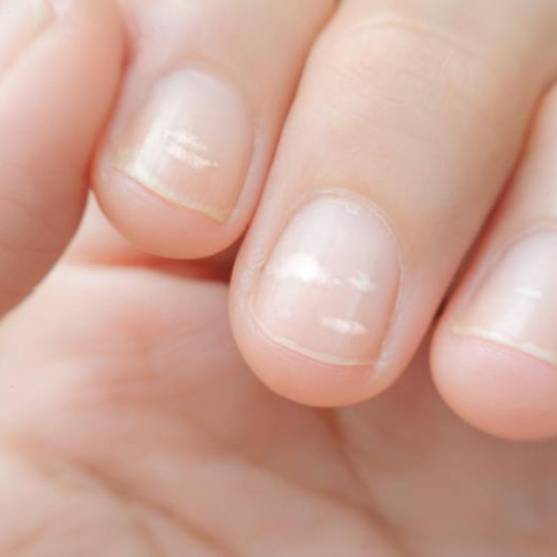 Munculnya Garis atau Titik Pada Kuku