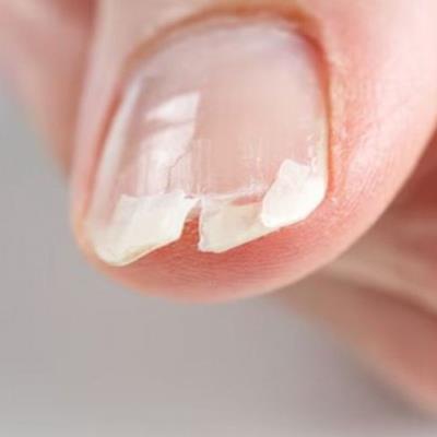 Kuku Rapuh atau Mudah Pecah