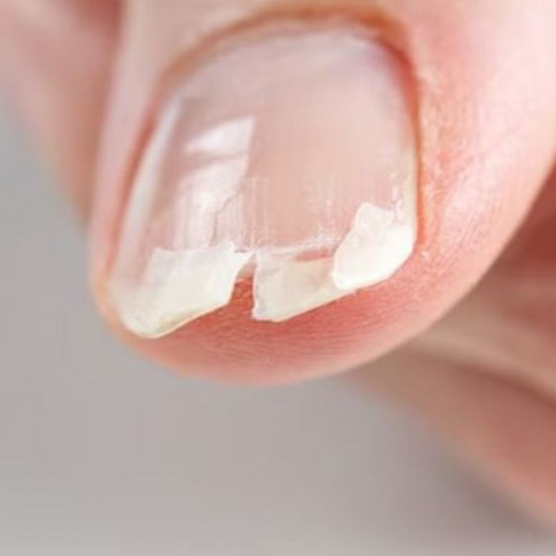 Kuku Rapuh atau Mudah Pecah